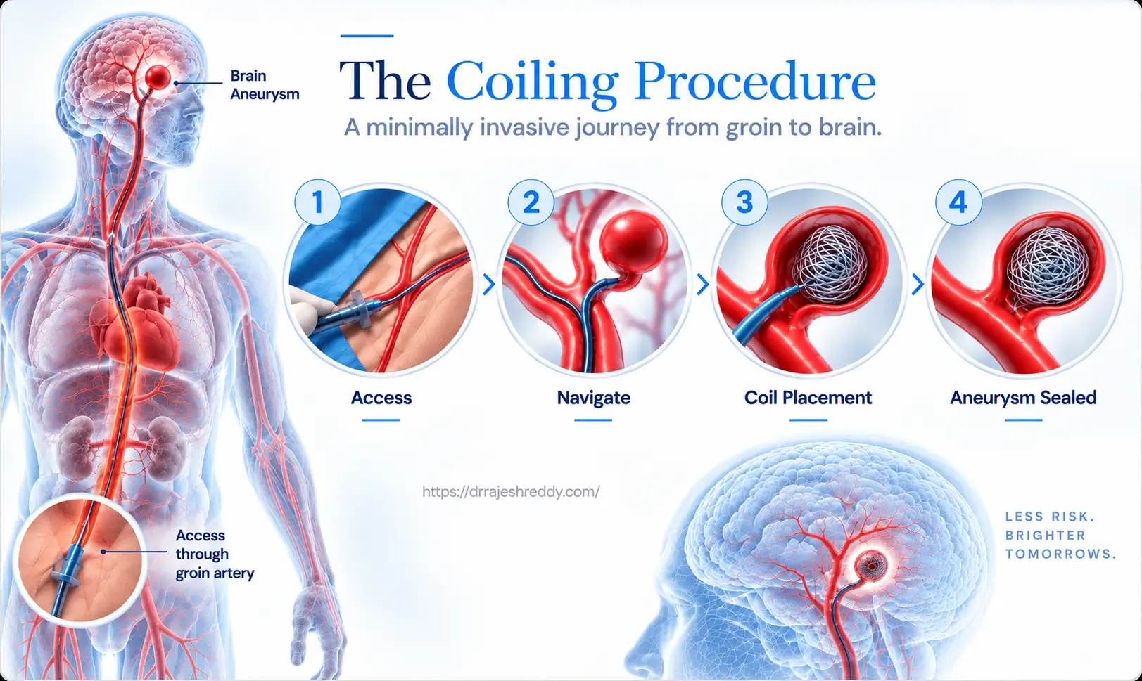 The Endovascular Coiling Procedure Step by Step